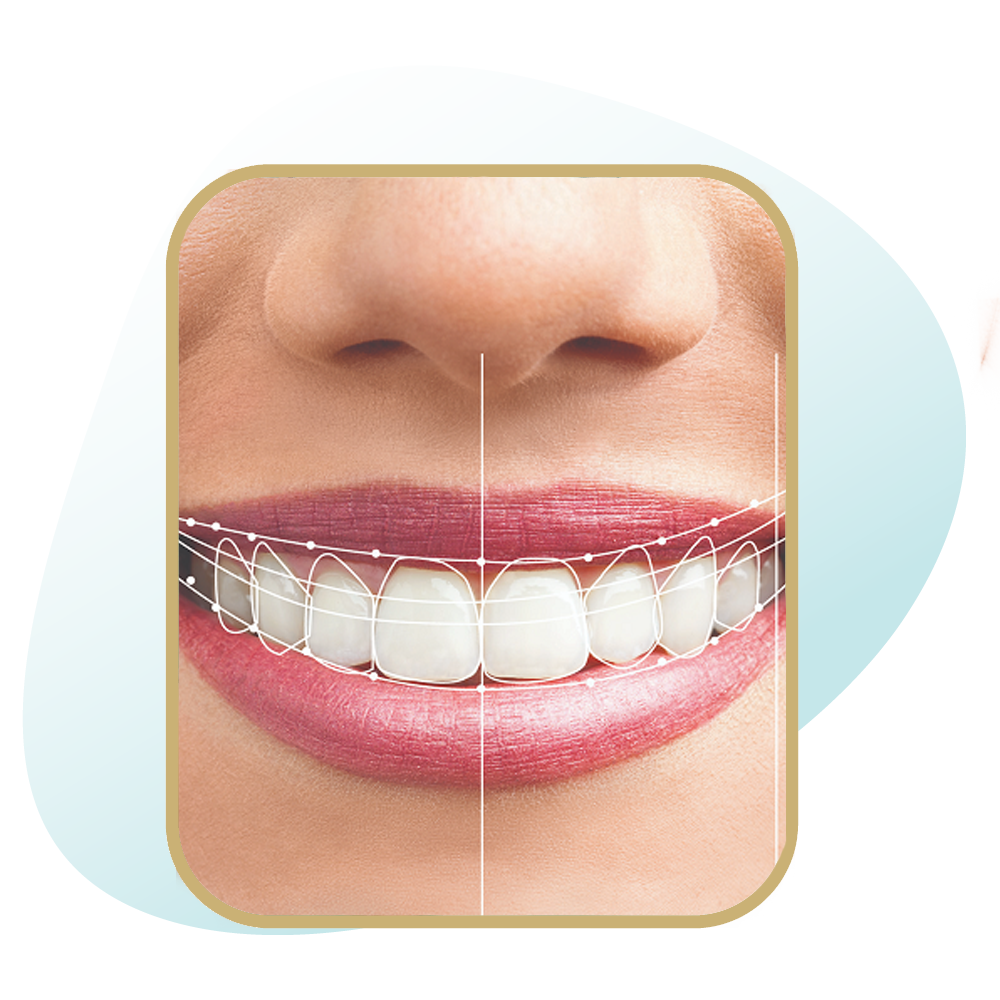 اصلاح طرح لبخند و یا طراحی لبخند