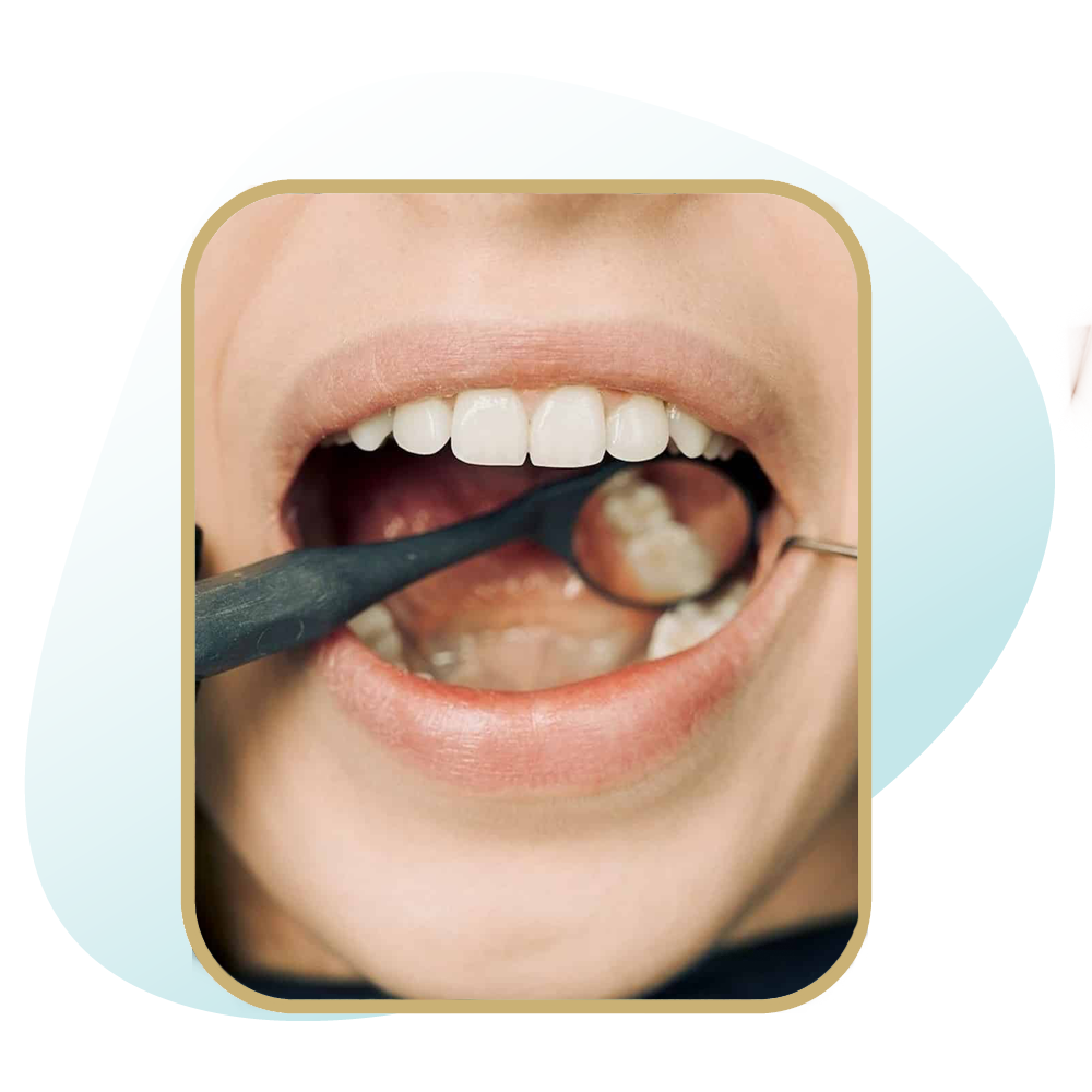 ترمیم و پر کردن دندان ها